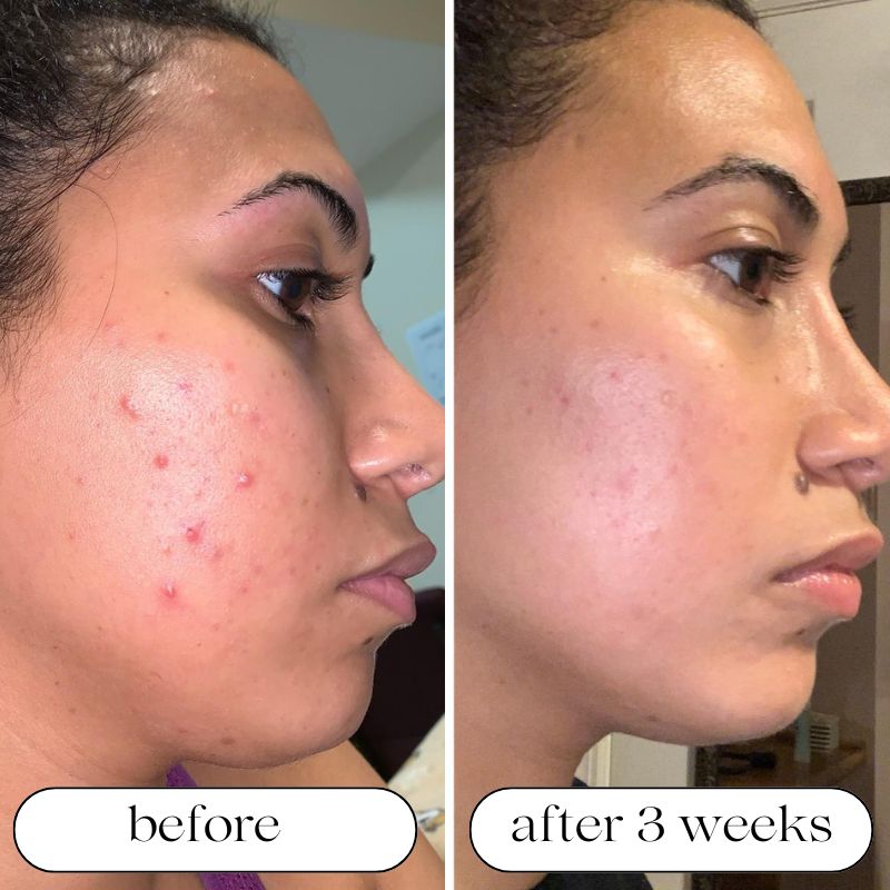 Before and After using Light Therapy 3