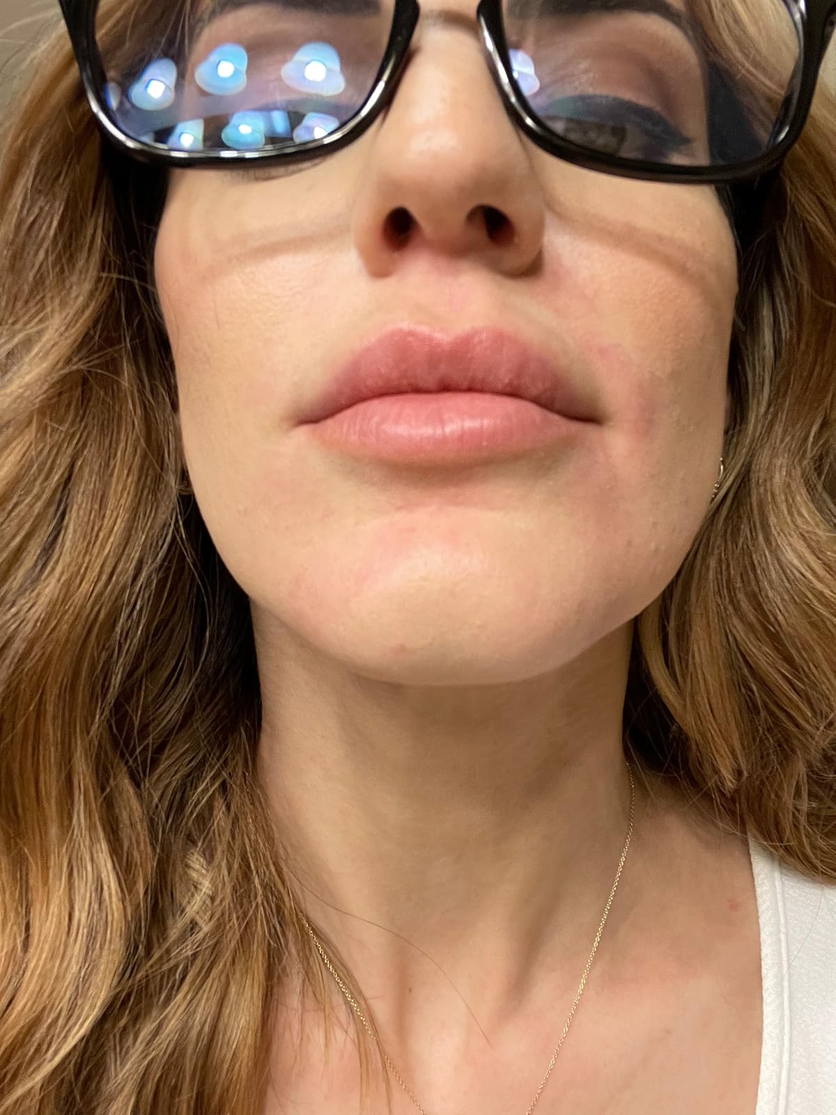 acne scarring after using led light therapy mask