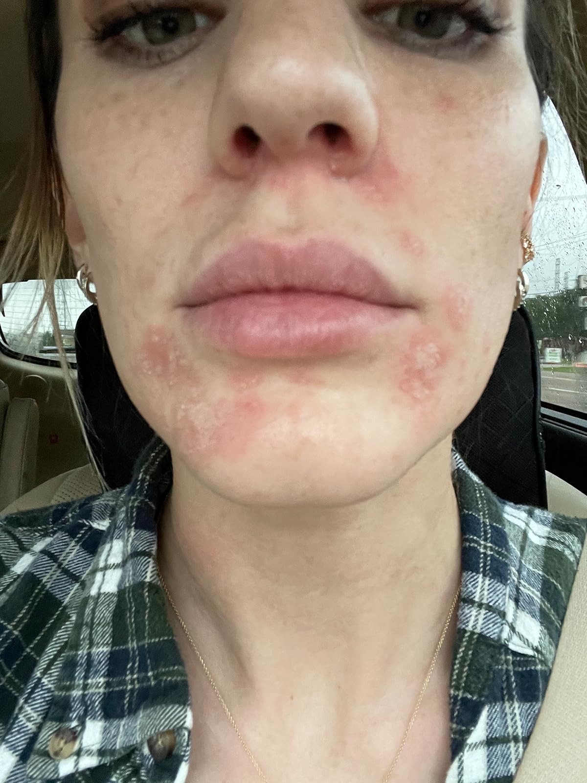 acne scarring before using led light therapy mask