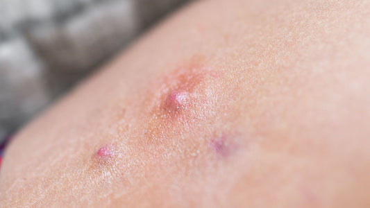 close up of boil from Hidradenitis Suppurativa