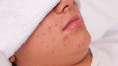 close up photo of young person with acne around nose, chin and cheeks