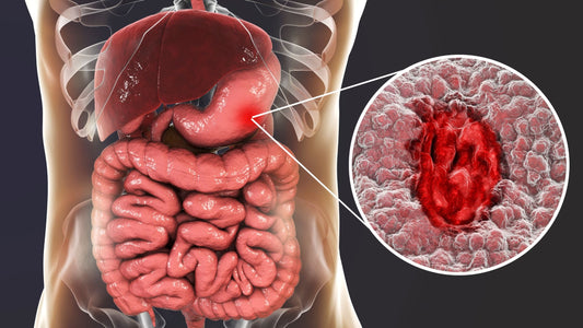 Ulcerative Colitis
