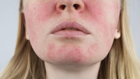 close up of woman with red cheeks and chin