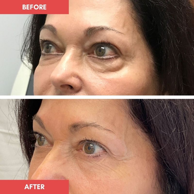 Aimee_eye_mask_before_and_after_4