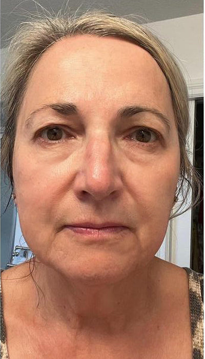 Anti-Ageing - After