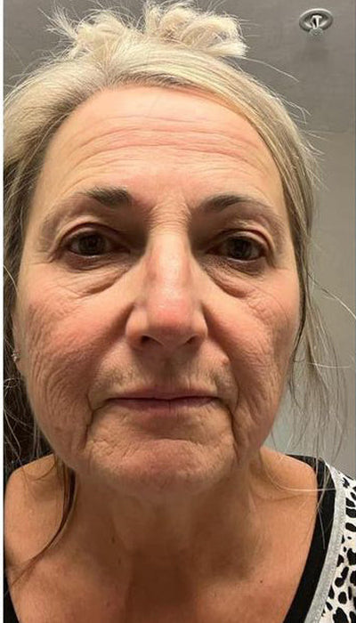 Anti-Ageing - Before
