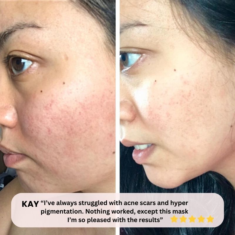 Before_and_Afte_use_for_LED_Light_therapy_mask