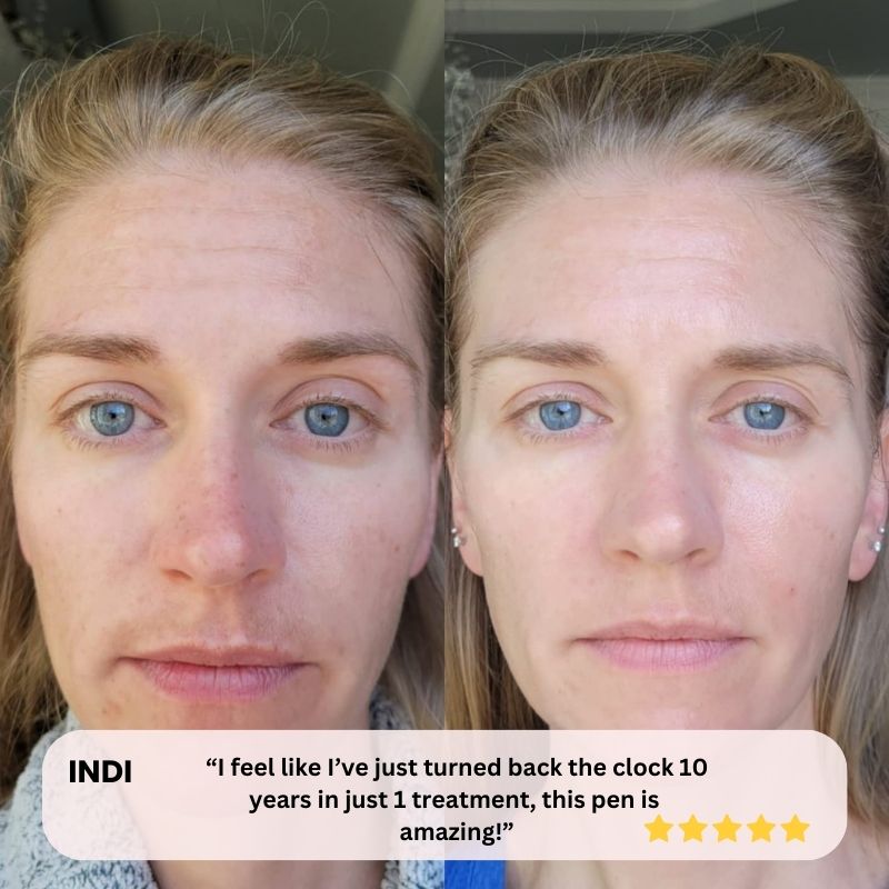 Pen Ultima M8 Microneedling Pen – StreamShop Australia