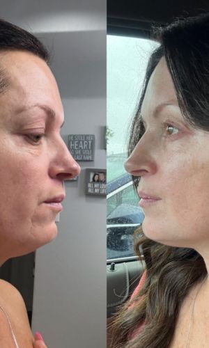 Before_and_after_of_woman_using_face_sculpting_tool