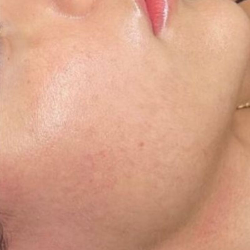 Kinder efter Microneedling-pen