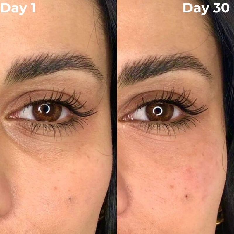 Day_1_vs_Day_30_Under_Eyes_2