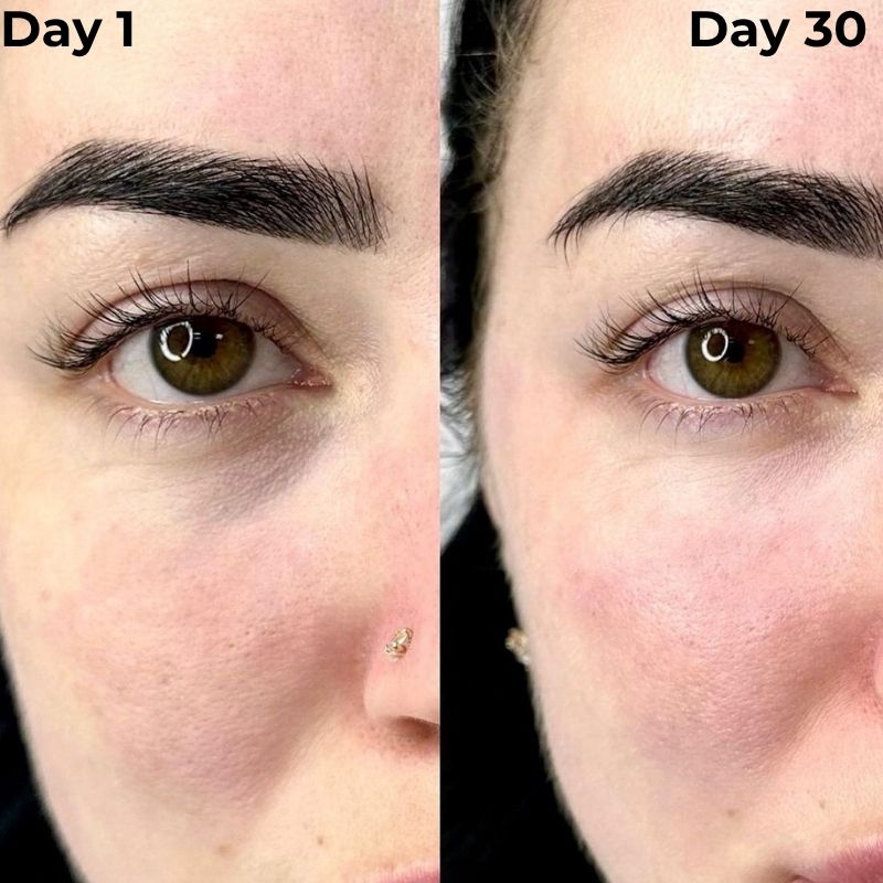 Day_1_vs_Day_30_Under_Eyes_3