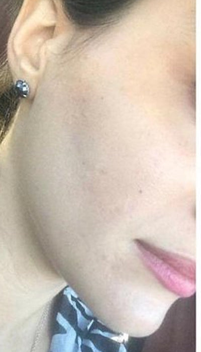 Acne - After