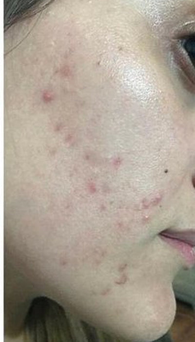 Acne - Before