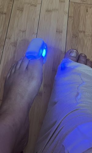Fungas_Laser_Device_on_Mans_Big_Toe_in_White