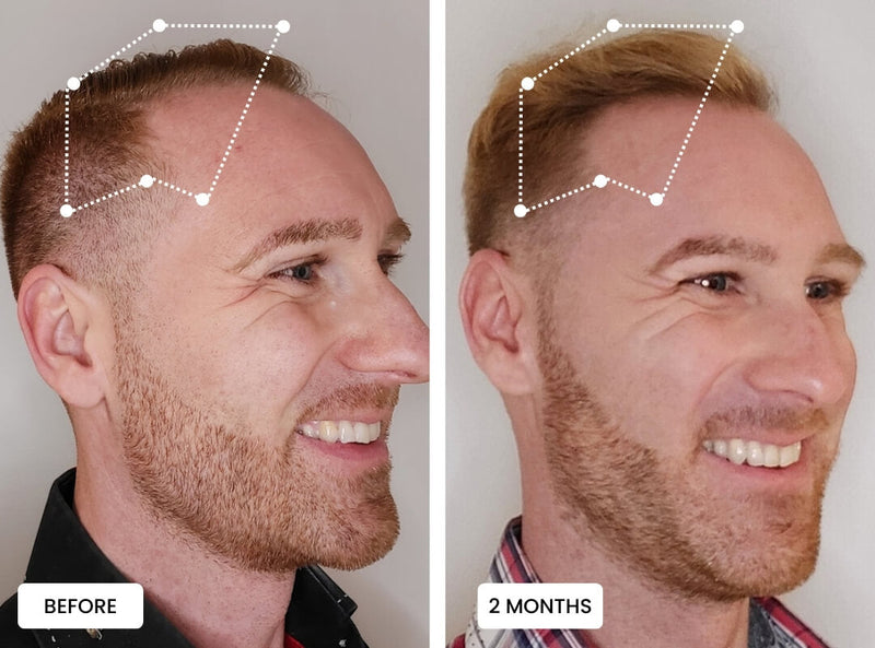 Hair_Growth_Before_And_After_2