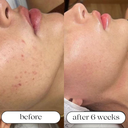 Before and After using Light Therapy 2
