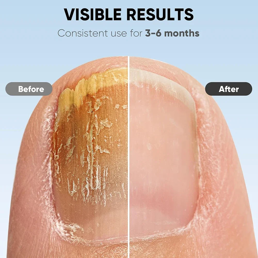 Laser Treatment Device for Nail Fungus before and after