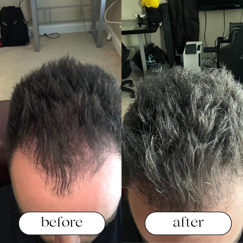 Red Light Therapy Caps for Hair Regrowth: Do They Actually Work Red Light Therapy Caps for Hair Regrowth: Do They Actually Work
