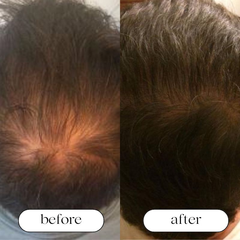 Red Light Therapy Cap with before and after of middle aged man.jpg__PID:39dfef7e-7f62-49b8-9e54-a16233c9e43f