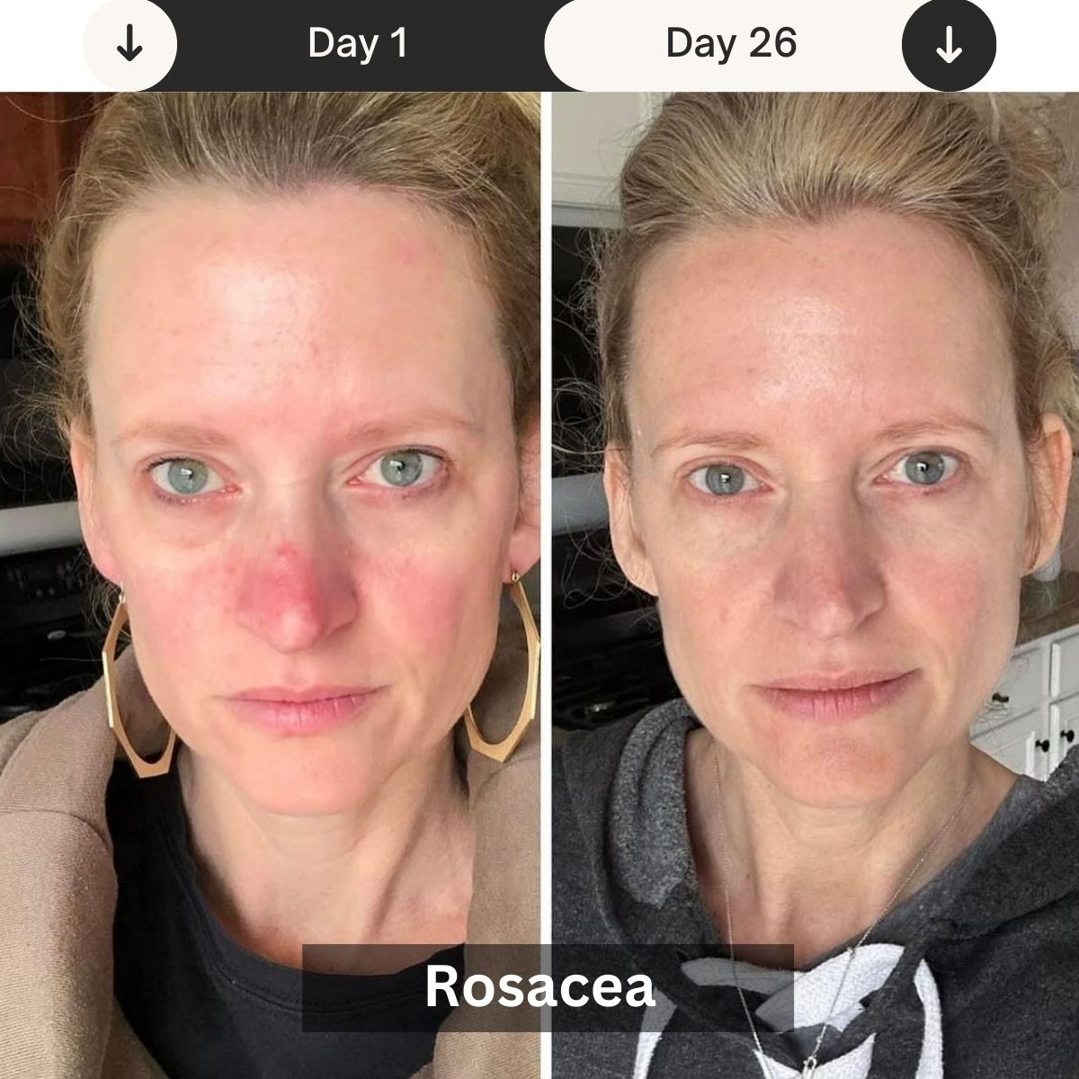 Rosacea_review_led_therapy_1