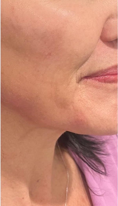 Smile Lines - After