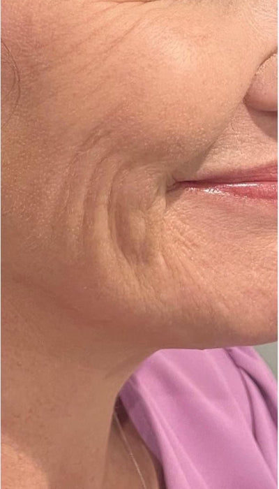 Smile Lines - Before