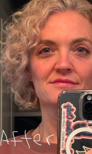 Woman_doing_a_mirror_selfie_of_the_after_effect_of_rf_device