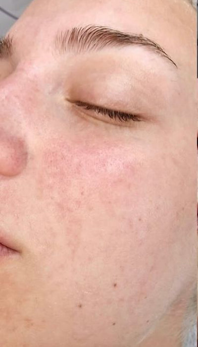 Acne - After