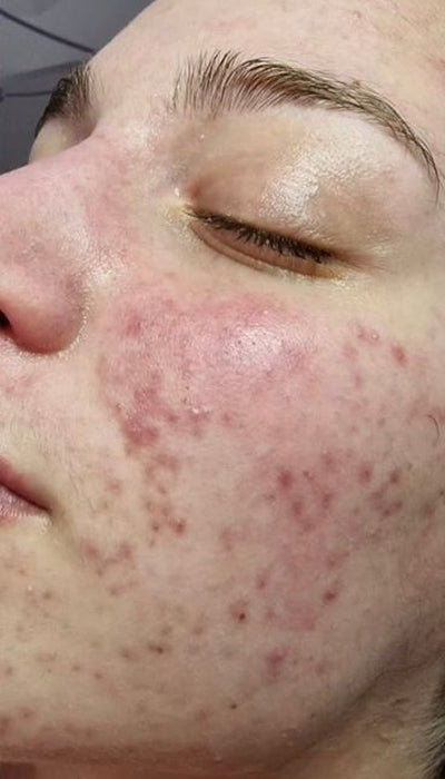 Acne - Before