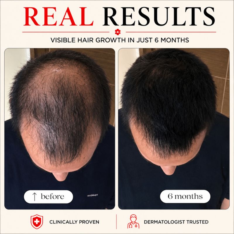 before_and_after_of_using_laser_light_therapy_helmet_2