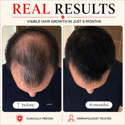 before_and_after_of_using_laser_light_therapy_helmet_2