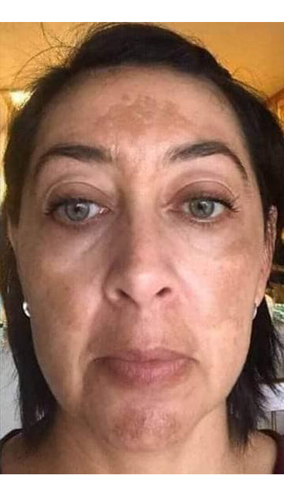 Pigmentation - Before