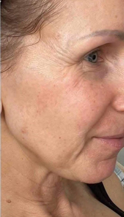 Anti-Ageing - Before