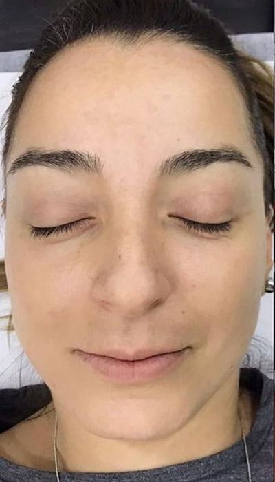 Pigmentation - After