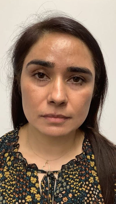 Hyperpigmentation - After