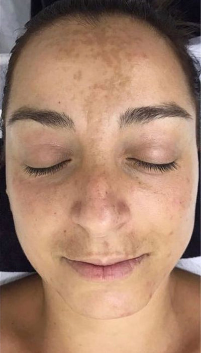 Pigmentation - Before