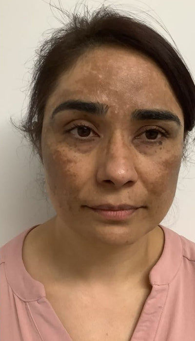 Hyperpigmentation - Before