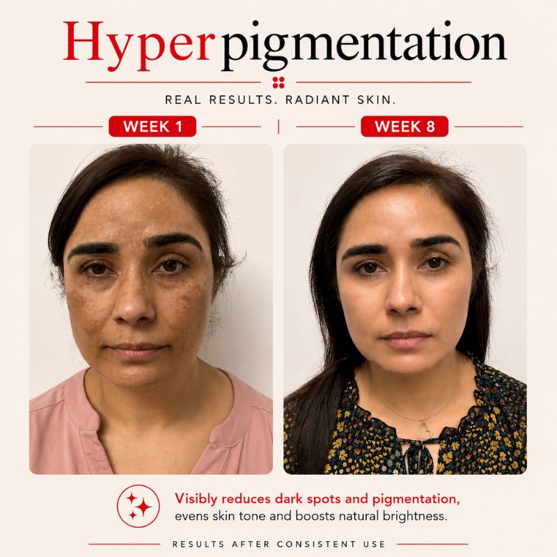 laser_mask_before_and_after_hyper_pigmentation