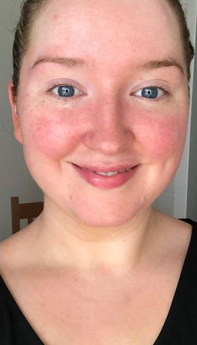 Redness - Before