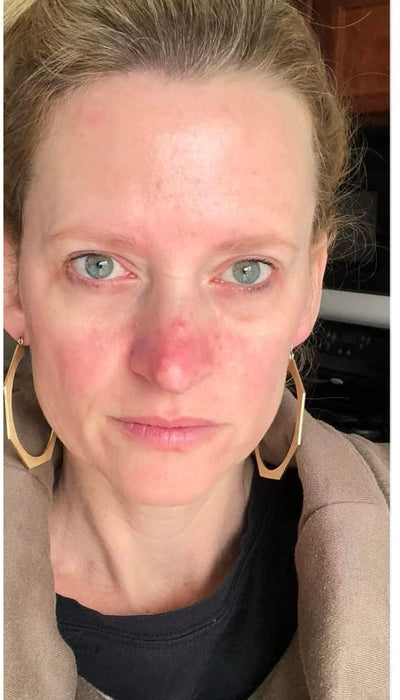 Rosacea - Before