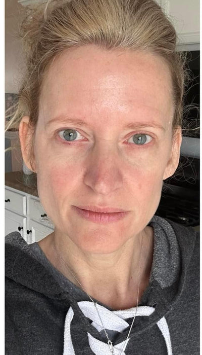 Rosacea - After