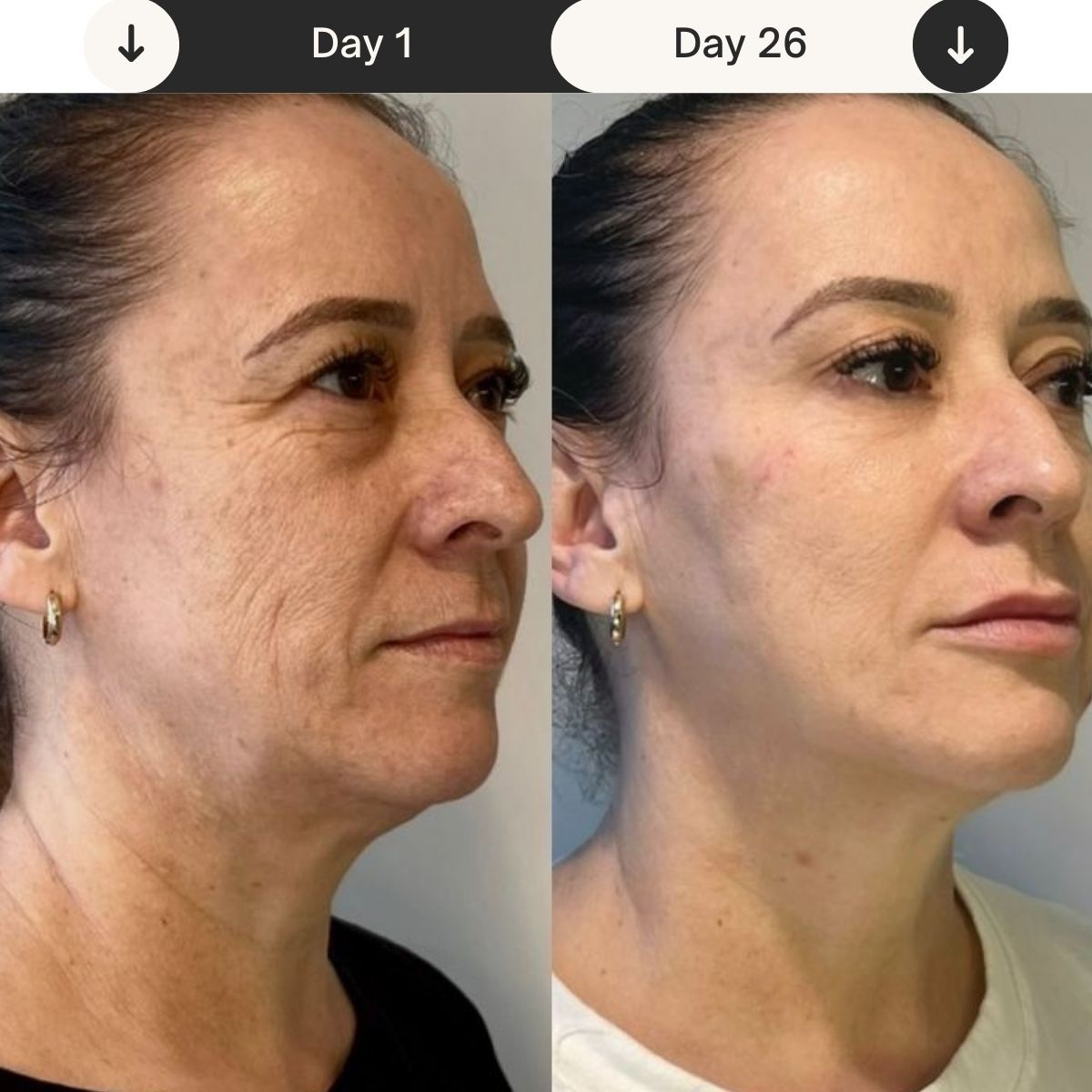 skin_tightening_before_and_after