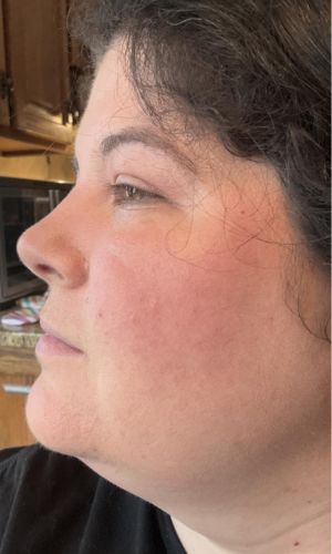 woman_showing_the_after_effects_of_the_rf_device_side_view