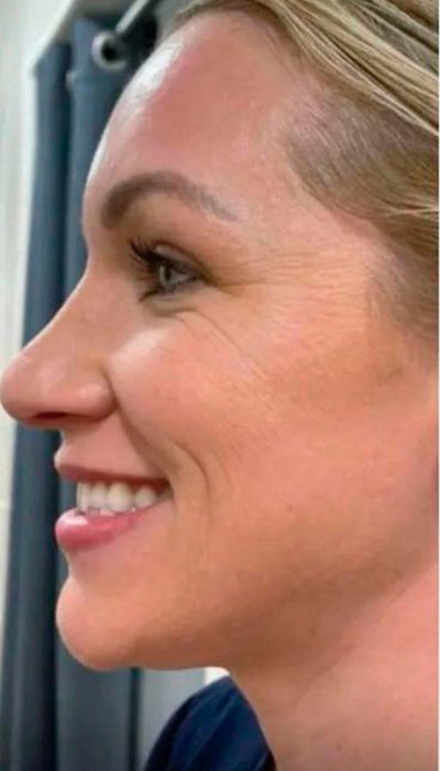 Fine Lines & Wrinkles - After