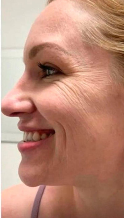 Fine Lines & Wrinkles - Before